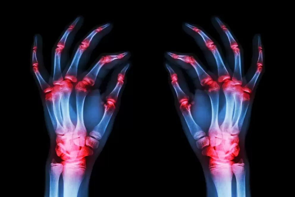 Osteoartritis de las articulaciones de los dedos. 