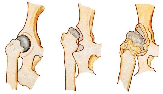 La displasia de cadera es una causa de coxartrosis secundaria. 