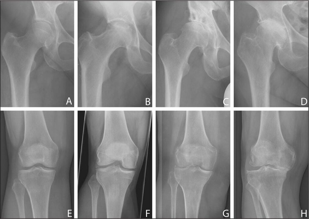 Osteoartritis de la articulación de la cadera en dinámica. 