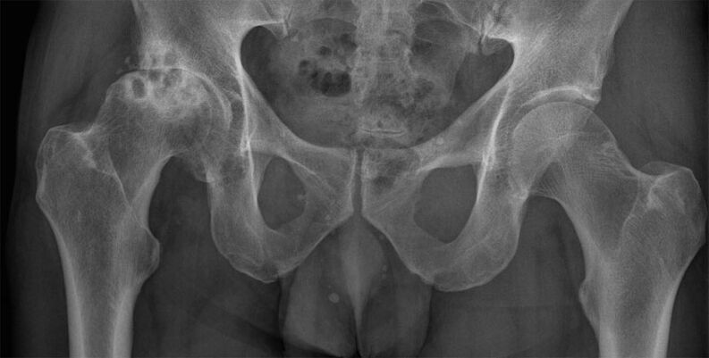 Osteoartritis en etapa 3 de la articulación de la cadera en una radiografía