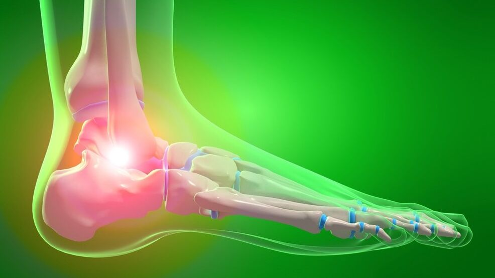 Osteoartritis de la articulación del tobillo. 