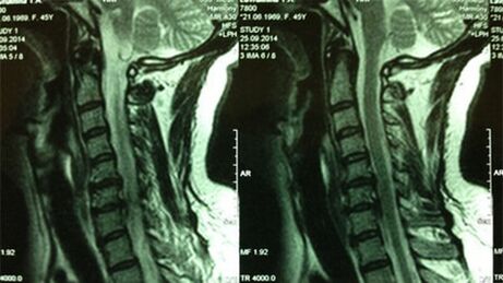MRI del departamento de cuello uterino