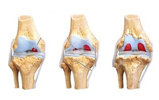 Etapas de la osteoartritis de la articulación de la rodilla. 