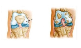 cambios patológicos en la osteoartritis de rodilla