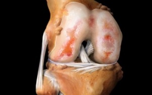¿Qué es la osteoartritis de rodilla 