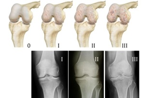 Métodos de diagnóstico de la osteoartritis de rodilla. 