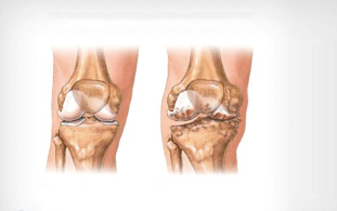 Osteoartritis de rodilla