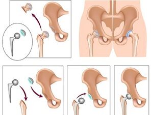 Endoprótesis para la osteoartritis de la articulación de la cadera