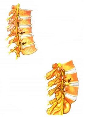 Ilustración de osteocondrosis de la columna vertebral. 