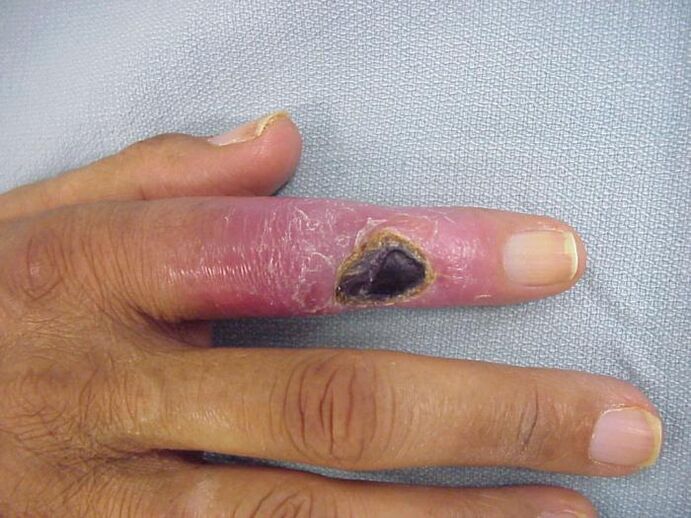 Osteomielitis como causa de dolor en las articulaciones de los dedos. 
