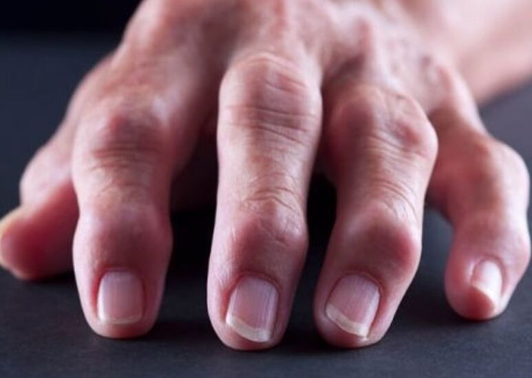 artritis reumatoide como causa de dolor en las articulaciones de los dedos
