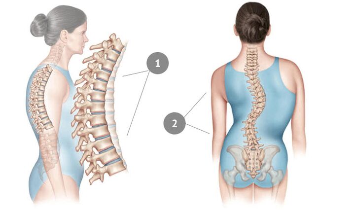 La curvatura espinal como causa de osteocondrosis torácica