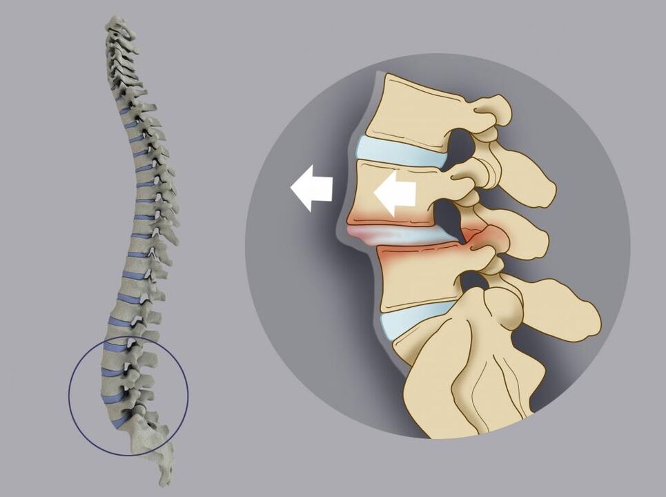 Desplazamiento de las vértebras como causa de dolor de espalda. 