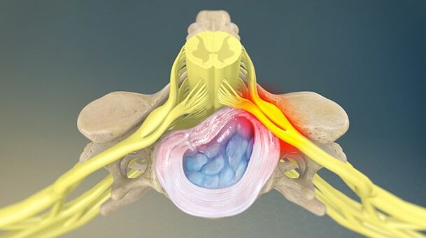 El síndrome radicular como causa de dolor de espalda. 