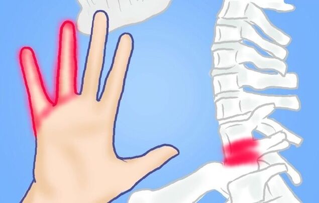 Nervios pinchados como causa de dolor de espalda